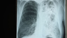 Legionella