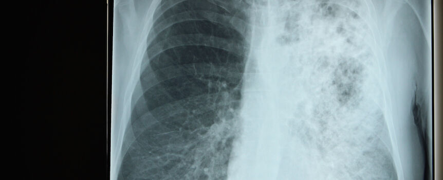 Legionella