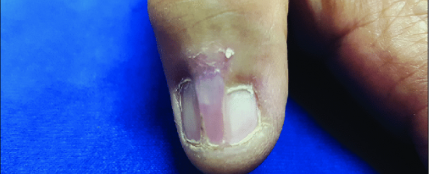 Nail Lichen Planus - Scientific Figure on ResearchGate. https://www.researchgate.net/figure/Extension-of-the-proximal-nail-fold-over-the-nail-plate-creating-split-portions-on-the_fig4_328018225 [accessed 13 Feb, 2023]