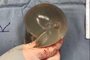 Implant piersi