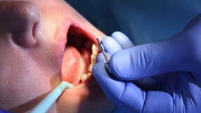 Implant dentystyczny