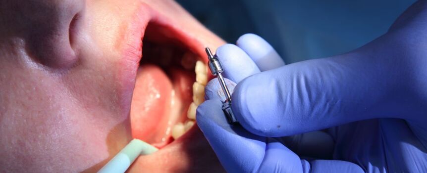 Implant dentystyczny