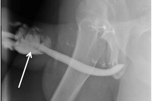 International Journal of Surgery Case Reports