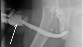 International Journal of Surgery Case Reports