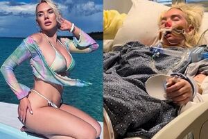 Modelka straciła nogę przez mięsożerną bakterię