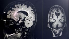 Samobójcza śmierć komórek mózgu prowadzi do Alzheimera. Ważne odkrycie