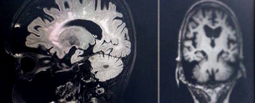 Samobójcza śmierć komórek mózgu prowadzi do Alzheimera. Ważne odkrycie