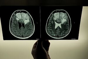 Jak zmniejszyć ryzyko udaru? Nowe wytyczne American Stroke Association 