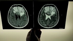 Jak zmniejszyć ryzyko udaru? Nowe wytyczne American Stroke Association 