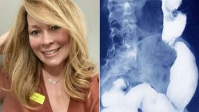 Sherri Rollins ostrzega przed rakiem jelita grubego
