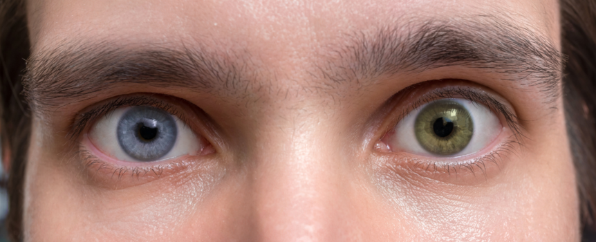 Heterochromia