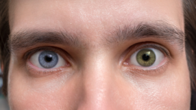 Heterochromia