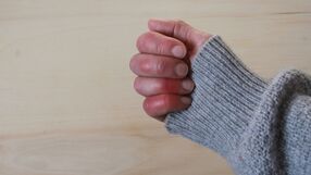 Ręka z odmrożoną skórą na mrozie