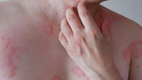 Alergia na histaminę - objawy 