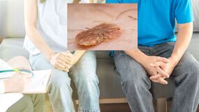 HPV objawy skórne