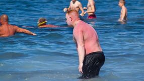 Oparzenia po opalaniu