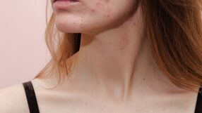 Trądzik hormonalny: jak rozpoznać? Dermatolodzy mówią o 5 sygnałach