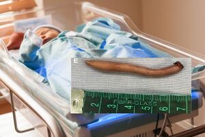 Shutterstock/ Journal of Pediatric Surgery Case Reports