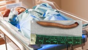 Shutterstock/ Journal of Pediatric Surgery Case Reports