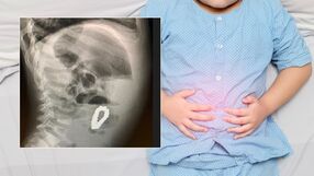 Shutterstock/ Journal of Pediatric Surgery Case Reports 