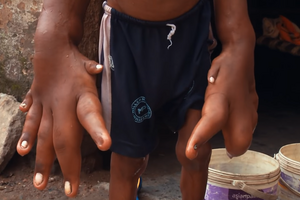 Shocking Lives  S1 ODC. 3/ Kaleem Mohammed Massive Hands/ screen YouTube