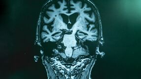 Ten test pomoże wykryć Alzheimera: przełom w leczeniu