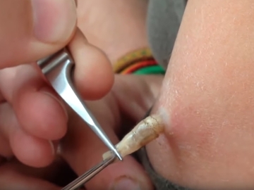 Larwy Gzu Ludzkiego Human Botfly W Skorze Czlowieka Czy To Bezpieczne Zdrowie