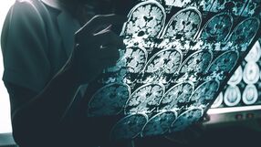 Choroba Alzheimera przyczyny