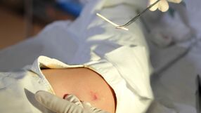 Kobieta straciła sprawność ręki przez implant antykoncepcyjny